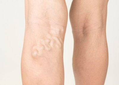 Venous Insufficiency