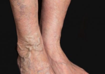 Venous Insufficiency