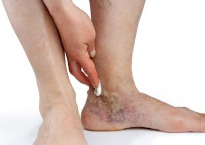 Venous Insufficiency