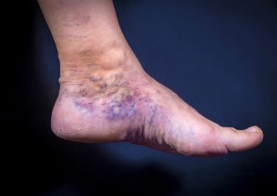 Venous Insufficiency