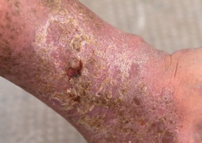 Venous Insufficiency