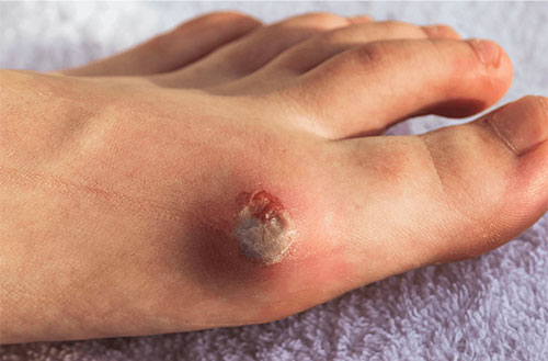 Arterial Ulcer