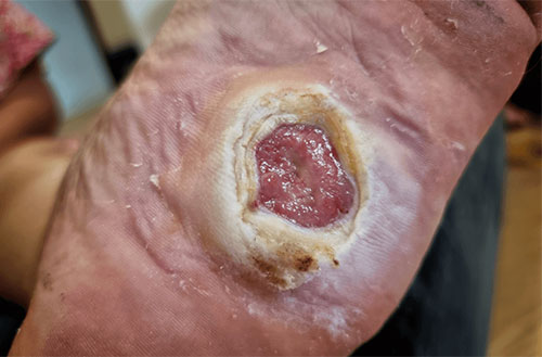 Arterial Ulcer