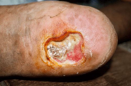 Arterial Ulcer