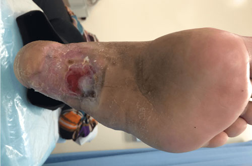 Arterial Ulcer