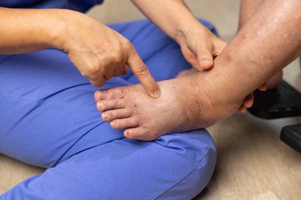 Common Causes Of Leg Swelling