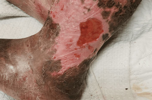 Venous Ulcer