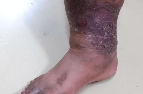 Venous Ulcer