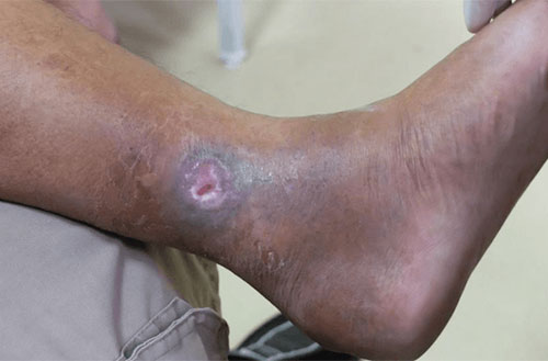 Venous Ulcer