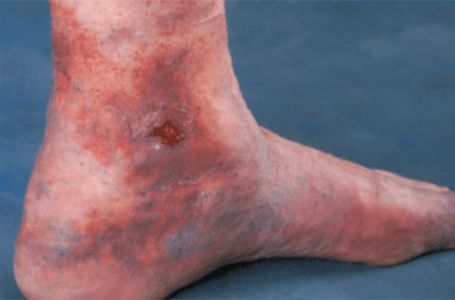 Venous Ulcer
